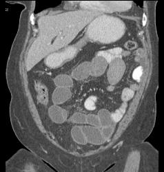 Small Bowel Obstruction (SBO) Due to Incarcerated Inguinal Hernia - CTisus CT Scan