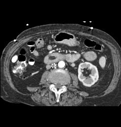 Duodenal Lipoma - CTisus CT Scan