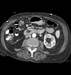 Duodenal Lipoma - CTisus CT Scan