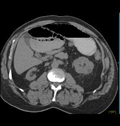 Small Bowel Obstruction (SBO) Due to Inguinal Hernia and Bowel Into Scrotum - CTisus CT Scan