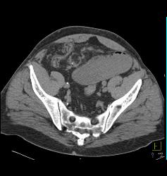 Small Bowel Obstruction (SBO) Due to Inguinal Hernia and Bowel Into Scrotum - CTisus CT Scan