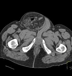 Small Bowel Obstruction (SBO) Due to Inguinal Hernia and Bowel Into Scrotum - CTisus CT Scan