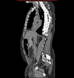 Small Bowel Obstruction (SBO) Due to Inguinal Hernia and Bowel Into Scrotum - CTisus CT Scan