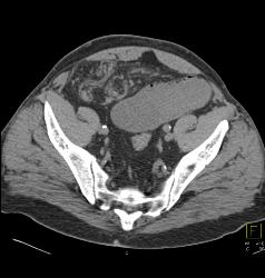 Small Bowel Obstruction (SBO) Due to Inguinal Hernia and Bowel Into Scrotum - CTisus CT Scan