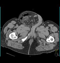 Small Bowel Obstruction (SBO) Due to Inguinal Hernia and Bowel Into Scrotum - CTisus CT Scan