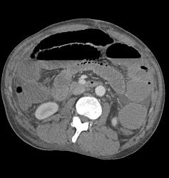 Small Bowel Obstruction (SBO) Due to Adhesions - CTisus CT Scan