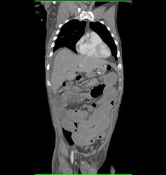 Small Bowel Obstruction (SBO) Due to Adhesions - CTisus CT Scan