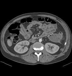 Abscess Near Small Bowel Mesentery - CTisus CT Scan