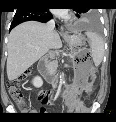 Abscess Near Small Bowel Mesentery - CTisus CT Scan