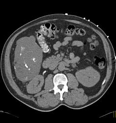 Incidental Tumor in Ruq- No Path Available - CTisus CT Scan