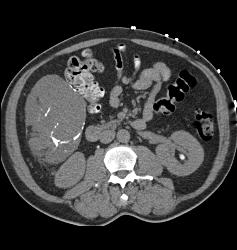 Incidental Tumor in Ruq- No Path Available - CTisus CT Scan