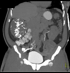 Incidental Tumor in Ruq- No Path Available - CTisus CT Scan