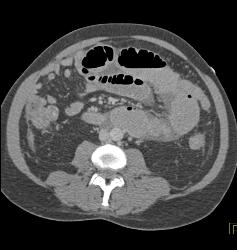 Small Bowel Obstruction (SBO) With Internal Hernia - CTisus CT Scan