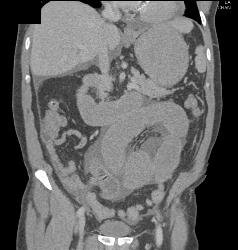 Small Bowel Obstruction (SBO) With Internal Hernia - CTisus CT Scan