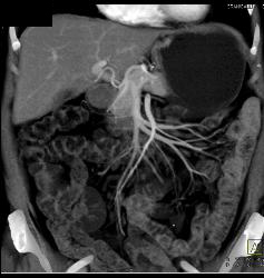 Mild Mesenteric Panniculitis- See Full Sequence of Images - CTisus CT Scan