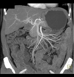 Mild Mesenteric Panniculitis- See Full Sequence of Images - CTisus CT Scan