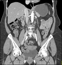 Mild Mesenteric Panniculitis- See Full Sequence of Images - CTisus CT Scan