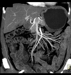 Mild Mesenteric Panniculitis- See Full Sequence of Images - CTisus CT Scan