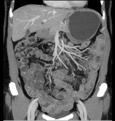 Mild Mesenteric Panniculitis- See Full Sequence of Images - CTisus CT Scan