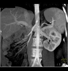 Malrotation - CTisus CT Scan