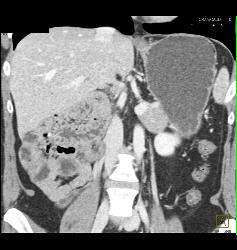 Malrotation - CTisus CT Scan