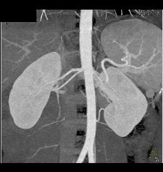 Malrotation - CTisus CT Scan