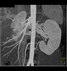 Malrotation - CTisus CT Scan