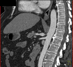 Celiac Artery Aneurysm - CTisus CT Scan