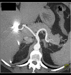 Celiac Artery Aneurysm - CTisus CT Scan