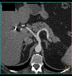 Celiac Artery Aneurysm - CTisus CT Scan