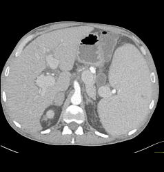 Wet Bowel and Splenomegaly in Patient With Immune Deficiency - CTisus CT Scan