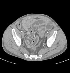 Wet Bowel and Splenomegaly in Patient With Immune Deficiency - CTisus CT Scan