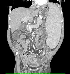 Wet Bowel and Splenomegaly in Patient With Immune Deficiency - CTisus CT Scan