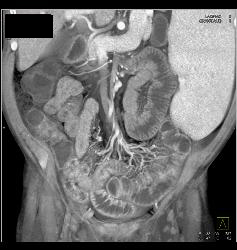 Wet Bowel and Splenomegaly in Patient With Immune Deficiency - CTisus CT Scan