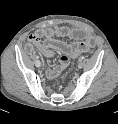 Wet Bowel and Splenomegaly in Patient With Immune Deficiency - CTisus CT Scan