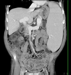 Wet Bowel and Splenomegaly in Patient With Immune Deficiency - CTisus CT Scan