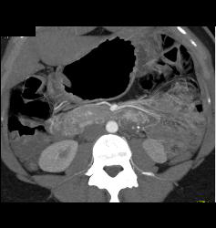 Vascular Tumor Infiltrates 3rd and 4th Portion of Duodenum- Key Is Thick Duodenum Enhancement - CTisus CT Scan