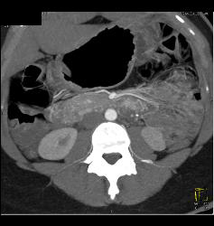 Vascular Tumor Infiltrates 3rd and 4th Portion of Duodenum- Key Is Thick Duodenum Enhancement - CTisus CT Scan