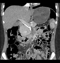 Vascular Tumor Infiltrates 3rd and 4th Portion of Duodenum- Key Is Thick Duodenum Enhancement - CTisus CT Scan