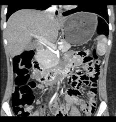 Vascular Tumor Infiltrates 3rd and 4th Portion of Duodenum- Key Is Thick Duodenum Enhancement - CTisus CT Scan