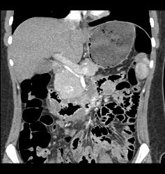 Vascular Tumor Infiltrates 3rd and 4th Portion of Duodenum- Key Is Thick Duodenum Enhancement - CTisus CT Scan