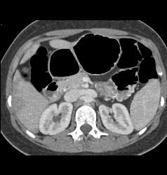 Vascular Tumor Infiltrates 3rd and 4th Portion of Duodenum- Key Is Thick Duodenum Enhancement - CTisus CT Scan