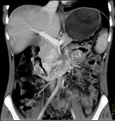 Vascular Tumor Infiltrates 3rd and 4th Portion of Duodenum- Key Is Thick Duodenum Enhancement - CTisus CT Scan