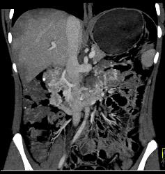 Vascular Tumor Infiltrates 3rd and 4th Portion of Duodenum- Key Is Thick Duodenum Enhancement - CTisus CT Scan