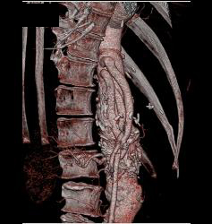 Bypass Grafts in Patient With Diseased SMA/celiac - CTisus CT Scan