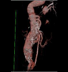 Bypass Grafts in Patient With Diseased SMA/celiac - CTisus CT Scan