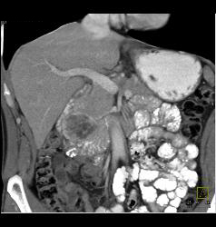 GIST Tumor Duodenum - CTisus CT Scan