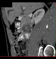 GIST Tumor Duodenum - CTisus CT Scan