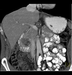 GIST Tumor Duodenum - CTisus CT Scan