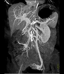 Pancreatic Cancer and Sclerosing Mesenteritis - CTisus CT Scan